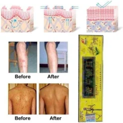 Psoriasis/exzeem Chineese Creme -Zacht Huid Verkoop 1195x1200 10