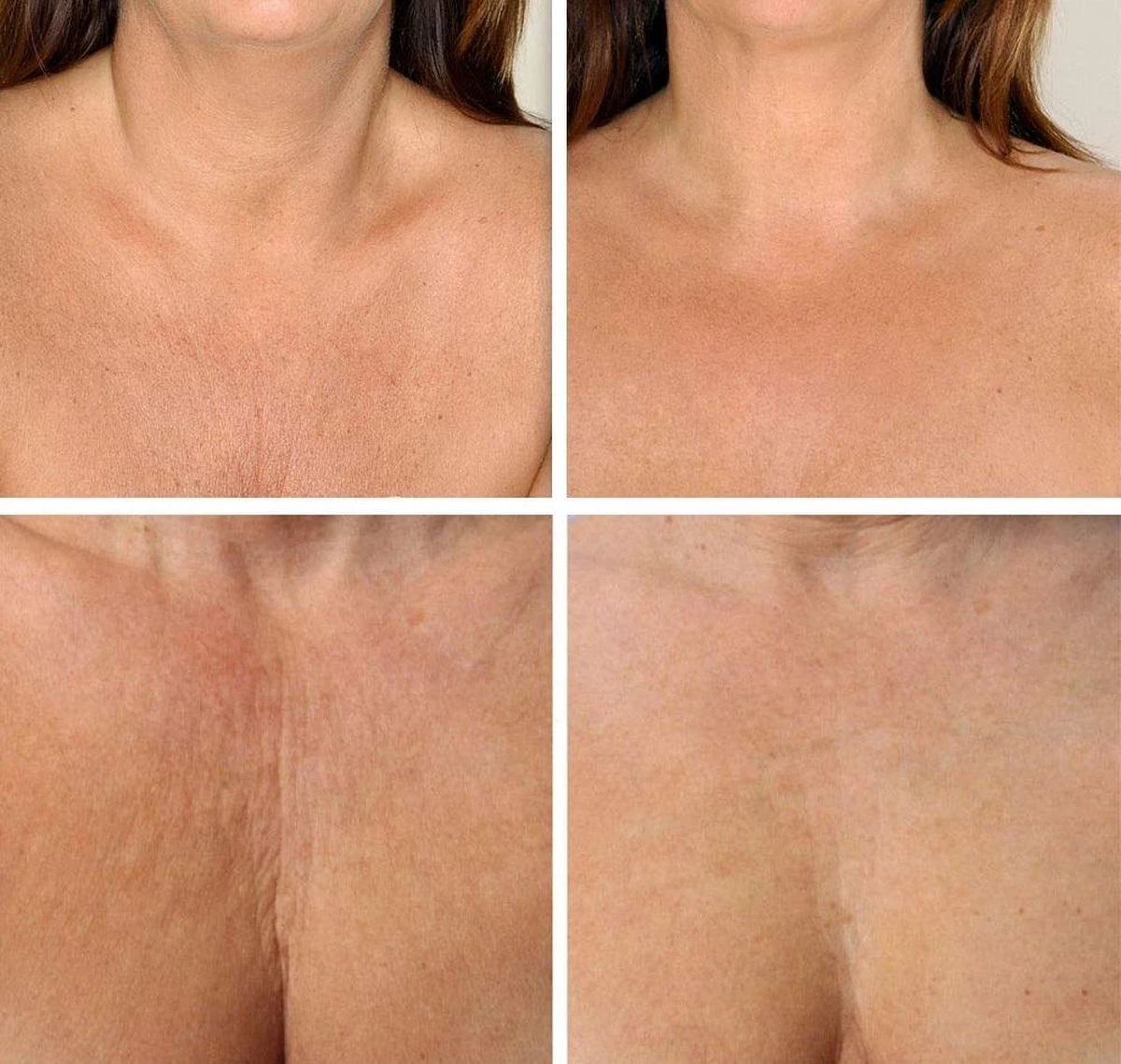 Simia™ Anti Rimpel Beauty Pads - Decolleté Large T Shape Set (2 Stuks) - Herbruikbaar Anti Aging Siliconen Pad Tegen Lijntjes En Slaaprimpels 4 Simia™ Anti Rimpel Beauty Pads - Decolleté Large T Shape Set (2 Stuks) - Herbruikbaar Anti Aging Siliconen Pad Tegen Lijntjes En Slaaprimpels - Afbeelding 4