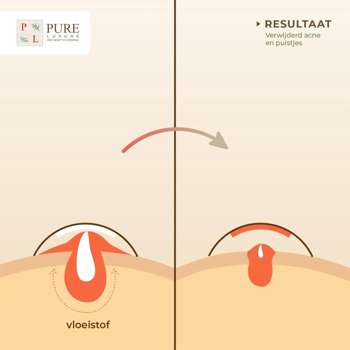 Pimple Patch 144 ST - Acne Patch - Acne - Acne Pleister - Pimple Patches - Puisten Verwijderaar 8 Pimple Patch 144 ST - Acne Patch - Acne - Acne Pleister - Pimple Patches - Puisten Verwijderaar - Afbeelding 8