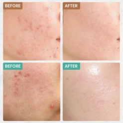 Jinius ® - Pimple Patches - Pimple Patch - Acne Patch - Puisten Verwijderaar - Puisten Pleister - Acne Pleister - Acne Sticker - Puistjes Verwijderen - 108 Stuks 6 Jinius ® - Pimple Patches - Pimple Patch - Acne Patch - Puisten Verwijderaar - Puisten Pleister - Acne Pleister - Acne Sticker - Puistjes Verwijderen - 108 Stuks -Zacht Huid Verkoop 1200x1200 971