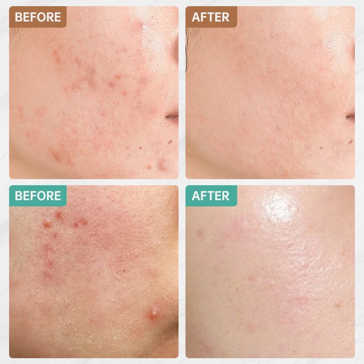 Jinius ® - Pimple Patches - Pimple Patch - Acne Patch - Puisten Verwijderaar - Puisten Pleister - Acne Pleister - Acne Sticker - Puistjes Verwijderen - 108 Stuks 3 Jinius ® - Pimple Patches - Pimple Patch - Acne Patch - Puisten Verwijderaar - Puisten Pleister - Acne Pleister - Acne Sticker - Puistjes Verwijderen - 108 Stuks - Afbeelding 3