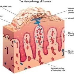 Psoriasis/exzeem Chineese Creme -Zacht Huid Verkoop 1200x919 1